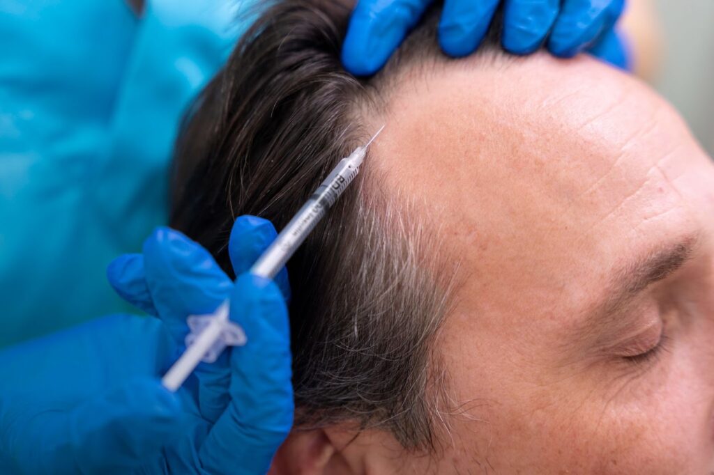 PRP injection being administered into a patient’s scalp